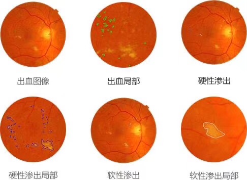 人工智能眼底筛查公益活动为多个社区送去健康福利