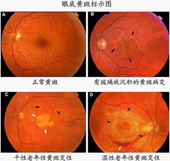 人工智能眼底筛查公益活动为多个社区送去健康福利